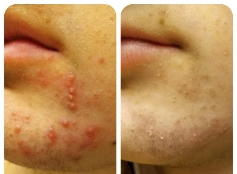 acne