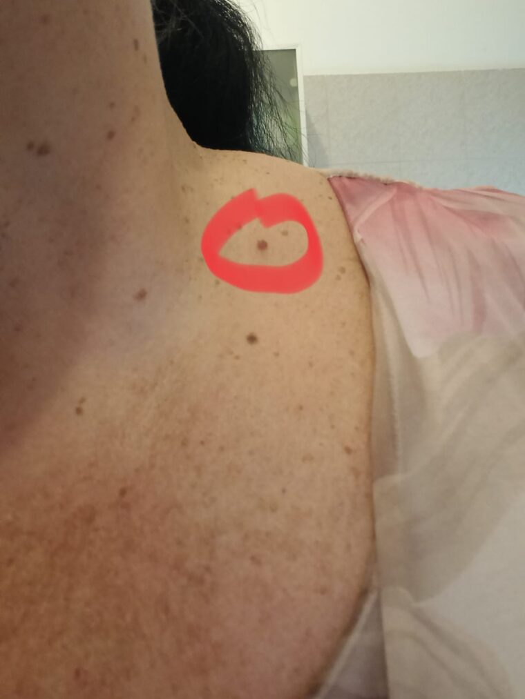 fibroma_pensuli